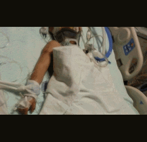 Cậu bé bị chó tấn công, mặt biến dạng