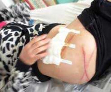 Nữ sinh lại bị rạch mông ở Khánh Hòa