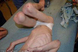 Đau lòng cậu bé 5 tuổi gầy trơ xương