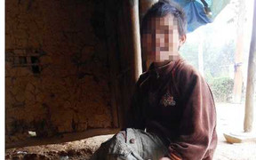 Bé gái có 2 răng mọc ngược và cách ăn kỳ lạ