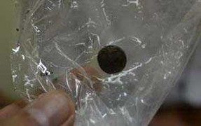 Đà Nẵng: Viên pin nằm trong mũi bệnh nhân suốt 5 năm