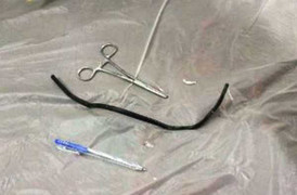 Dây điện dài 40cm nằm trong cơ thể 2 năm