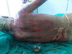 Kiểm điểm điều dưỡng viện Bỏng xúc phạm bệnh nhân