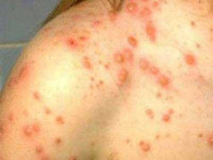 PGĐ viện Nhi: Ngành y nên công nhận dịch sởi