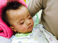 9 khuyến cáo nên đọc gấp để phòng chống bệnh sởi