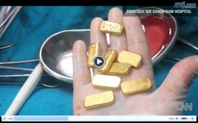 Clip: Tìm thấy 12 thỏi vàng trong bụng một doanh nhân