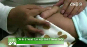 Trung Quốc: Cậu bé 5 tháng tuổi mọc đuôi