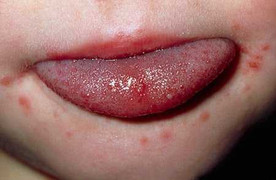 Cách tránh mắc bệnh tay chân miệng