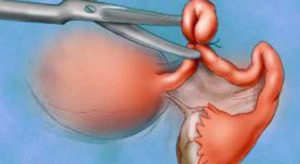 Chẩn đoán viêm ruột thừa nhưng mổ cắt... buồng trứng