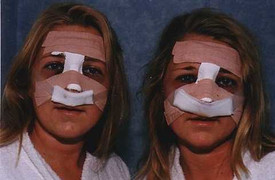 Phẫu thuật để giống nhau như đúc