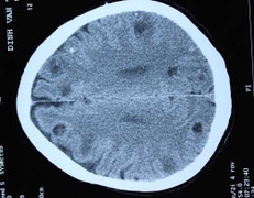 Không thể tin: 50 ổ sán làm tổ trong não