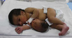 Bé sơ sinh có thêm đầu mọc ra từ bụng