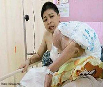 Khối u 20 kg lúc lỉu trên vai