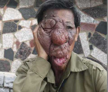 Người khốn khổ mang khuôn mặt không ai dám nhìn