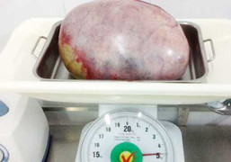 Khối u như quả dừa trong bụng thiếu nữ