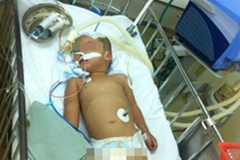 Ngã từ ban công, bé 3 tuổi chấn thương sọ não