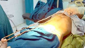 Dị vật dài 1,4m trong bàng quang bệnh nhân