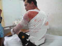 Lò thép nổ tung như pháo hoa: 2 người nhập viện đã tử vong