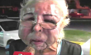 Cận cảnh khuôn mặt biến dạng kinh hoàng vì làm đẹp