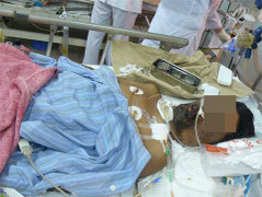 Kinh hoàng ăn tiết canh bị giun xoắn đóng tổ trong não