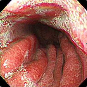 Quý ông kể về hành trình chữa khỏi loét dạ dày