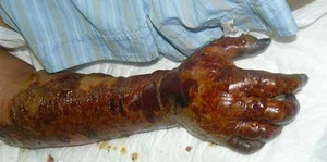 Vi khuẩn 'đục' tay sau khi dùng nước bẩn