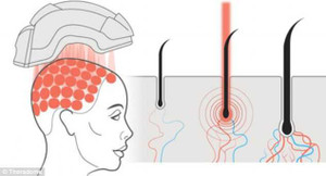 Xuất hiện mũ bảo hiểm làm mọc tóc