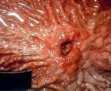 Người trẻ thế này đã thủng dạ dày