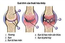 Bạn bị đau xương, khớp, phải làm sao?