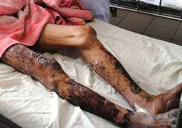 Tử vong vì xin thịt lợn chết về ăn