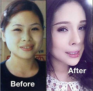 'Thoát xác' sau phẫu thuật đau đớn tột cùng