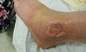 Nhện góa phụ và vết cắn kinh khủng