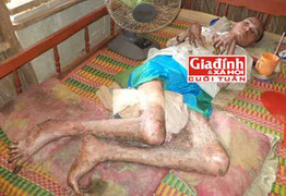 Bí ẩn chứng bệnh của người đàn ông 'hóa rắn' sau khi ăn rắn độc