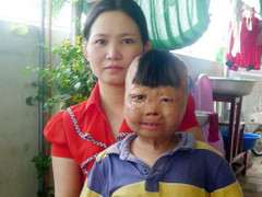 Chuyện đau lòng của người mẹ lột da đùi vá mặt cho con