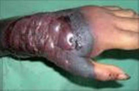 Tin sáng:Rumani xuất hiện trường hợp nghi nhiễm Ebola