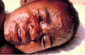 Biểu hiện và phòng bệnh Ebola