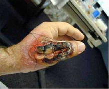 Vợ thất thần kể chuyện chồng bị nhện độc cắn chết