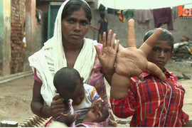 Kì lạ bé trai có bàn tay khổng lồ nặng 8kg