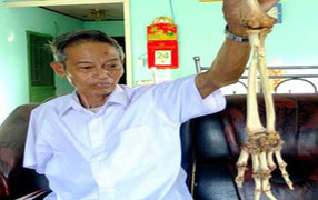 Chuyện người gặp lại… cánh tay mình sau nửa thế kỷ