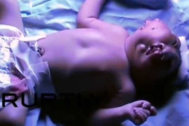Xót xa bé sơ sinh có 2 khuôn mặt trên 1 cái đầu