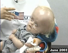 Cậu bé không não qua đời ở tuổi 12