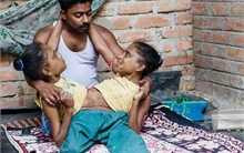 Chuyện tình kỳ lạ của chàng trai với cặp song sinh dính liền