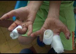 Clip: Đồ chơi Trung Quốc phát nổ, bé trai đứt tay, mắt hỏng nặng