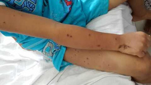 Ong vò vẽ đốt: Người chết, người nôn ra máu