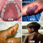 Ca bệnh Ebola đầu tiên tại Mỹ