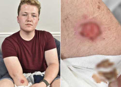 iPhone 5 nóng bất thường gây bỏng cho người dùng