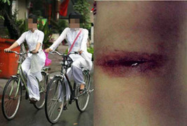 Nữ sinh Đồng Nai lại bị kẻ lạ rạch mông