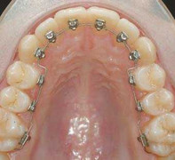 Sáng ngủ dậy tá hỏa phát hiện đã nuốt niềng răng