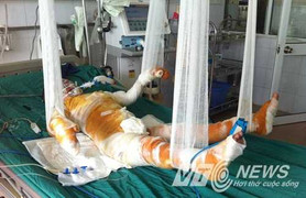 Xót xa cả gia đình bốc cháy nằm trên giường bệnh
