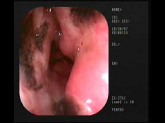 Đau dạ dày: Dùng thảo dược nào tránh suy gan, viêm thận